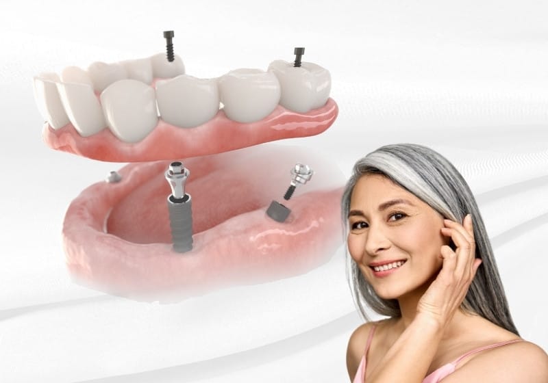 One woman and a large image of a implant supported denture.